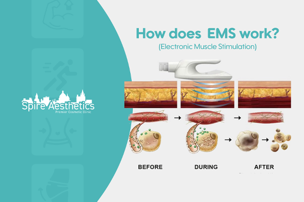 EMS treatment for post pregnancy weight loss treatment Nottinghamshire