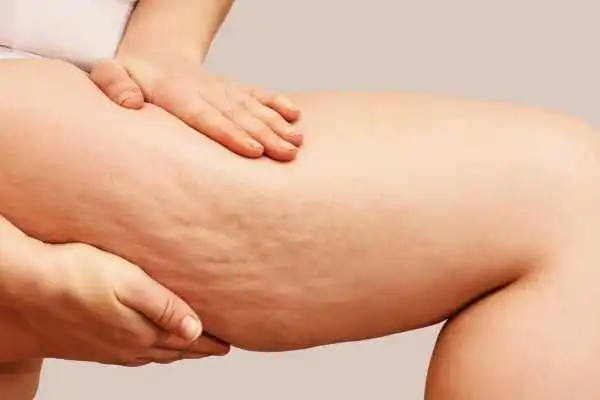 Image of woman showing leg with cellulite Nottinghamshire