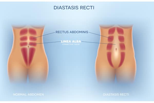 What Non-Surgical Options Are Available for Diastasis Recti Nottinghamshire?