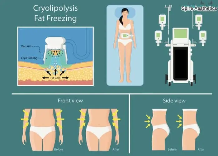 Fat freezing treatment Nottinghamshire benefits for competitions to remove stubborn fat deposits.