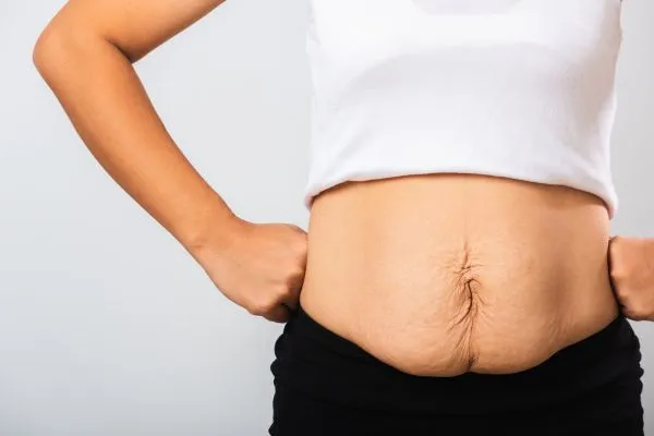 Image of a woman's stomach after weight loss with sagging skin following a gastric band Nottinghamshire