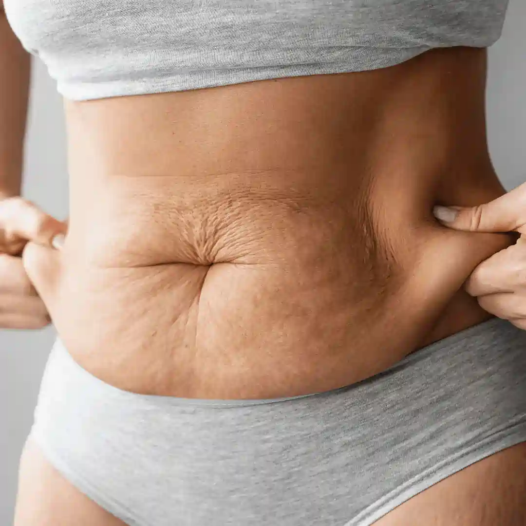 Is It Normal to Have Loose Skin After Pregnancy Nottinghamshire?