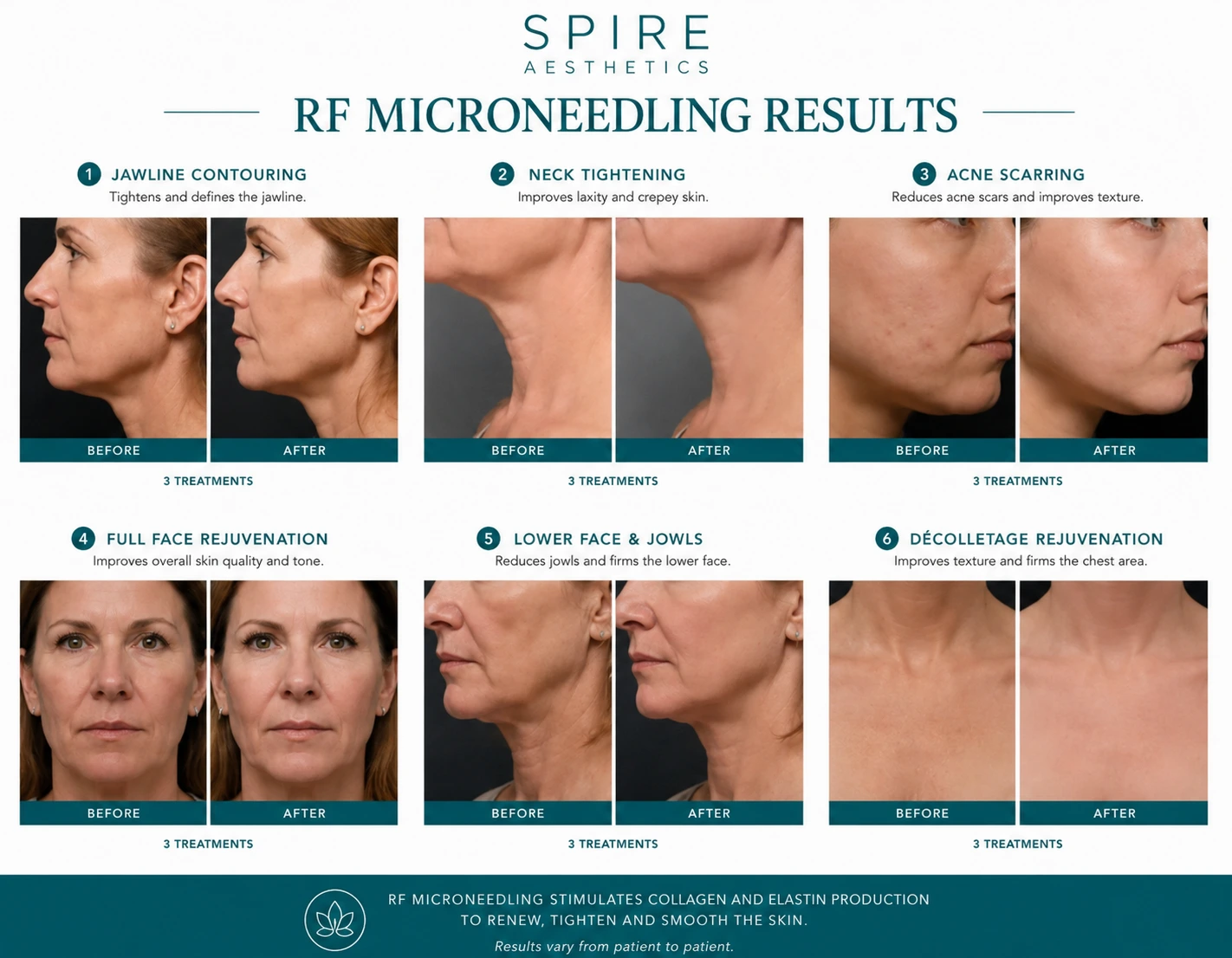 RF Microneedling Skin tightening Nottinghamshire results