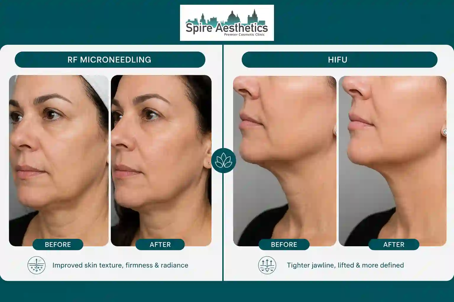 Can RF Microneedling and HIFU Be Combined Nottinghamshire?