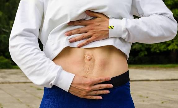 When Could Diastasis Recti Be the Missing Piece of the Puzzle Nottinghamshire?