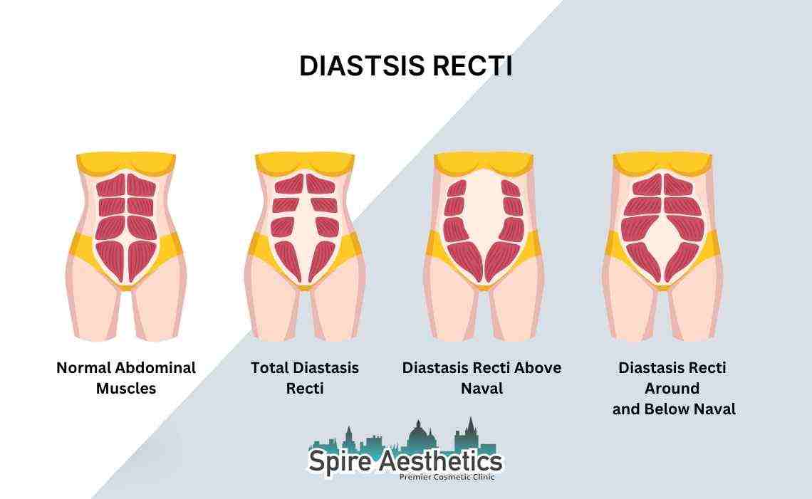 Is Non-Surgical Diastasis Recti Treatment Right for You? Common Concerns Answered Nottinghamshire